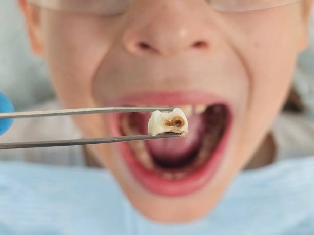 Best Emergency Treatment for Dental Infections or Abscesses in Tacoma, WA