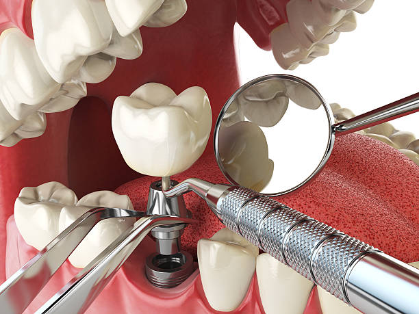 Best Emergency Denture Repair in Tacoma, WA